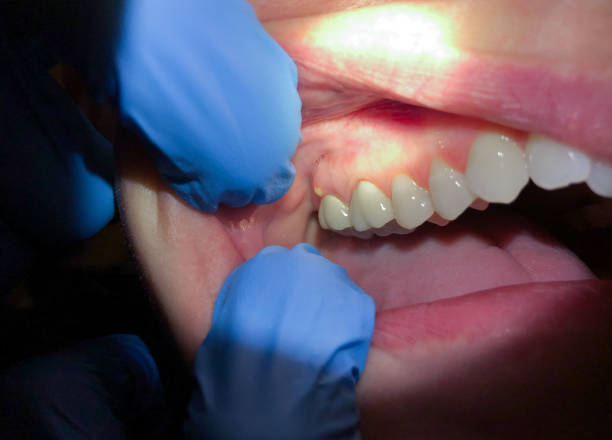 Best Broken or Cracked Tooth Emergency Dentist in Monroeville, OH
